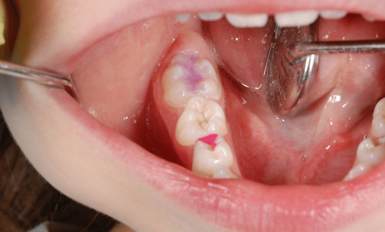 How Molarul Can Enhance Your Dental Destiny
