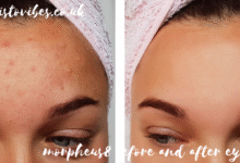 morpheus8 before and after eyes